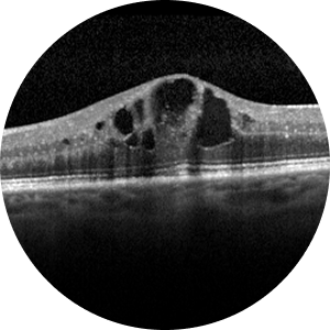 Diabetic Eye Diseases
