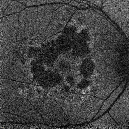 Foveal Involving GA