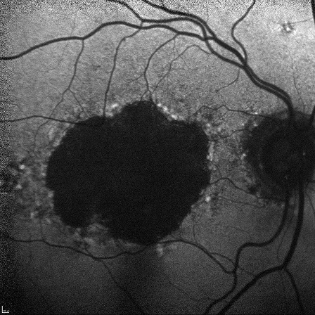 Foveal Sparing GA